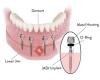 Dental Implant Solutions Wayne, NJ
