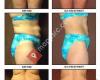 Elite Cellulite Solution