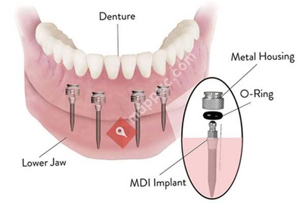 Dental Implant Solutions El Segundo, CA