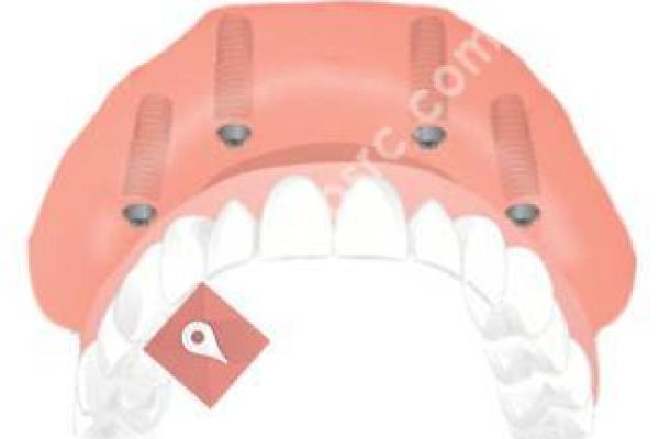 Dental Implant Solutions Greer, SC