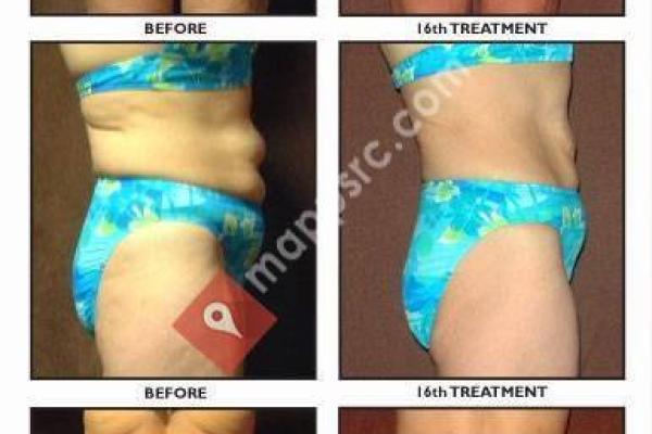 Elite Cellulite Solution